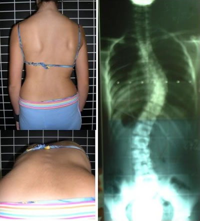 Adams test and x-ray show scoliosis